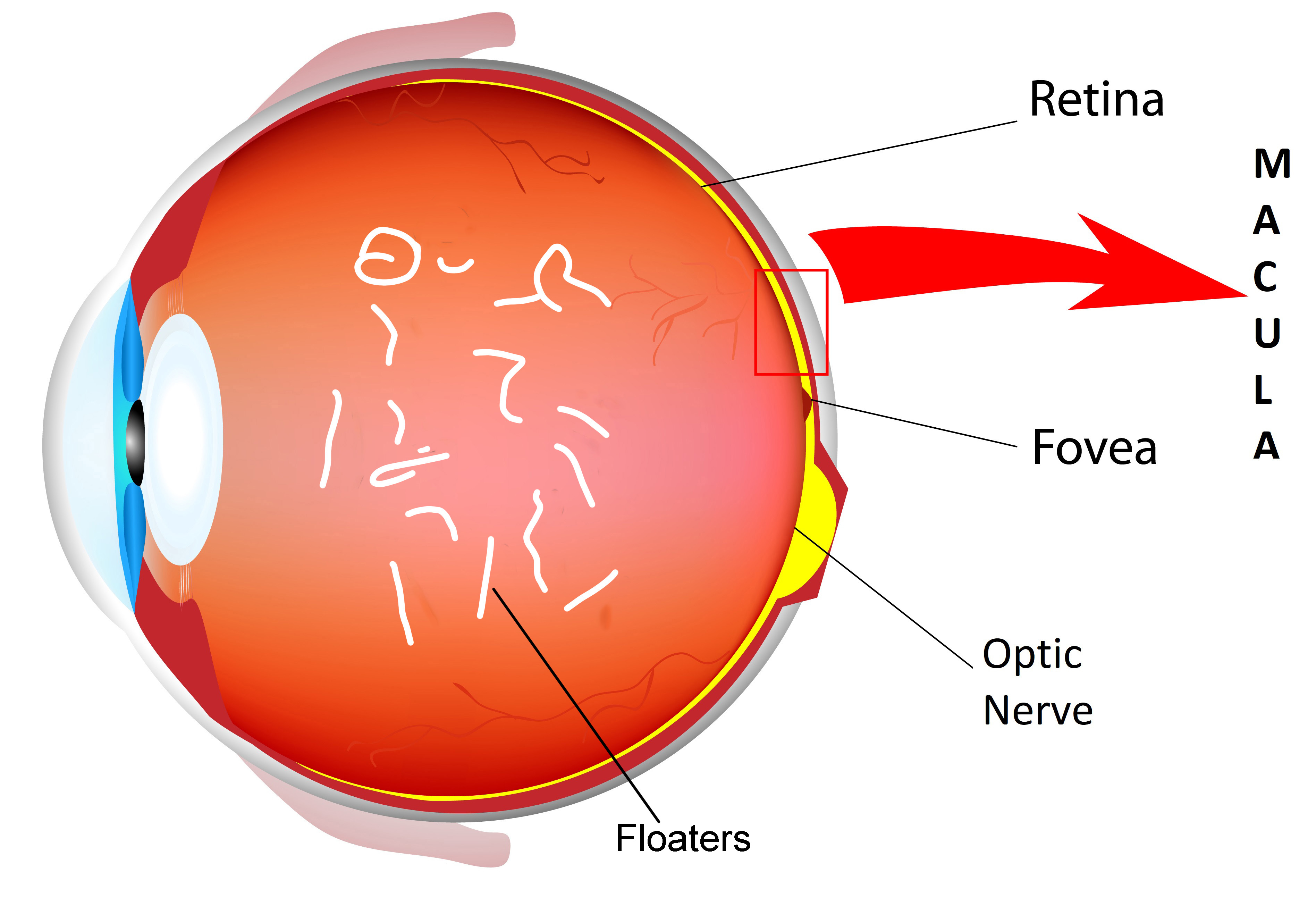 Floaters viswanathan shrewsbury retina surgeon